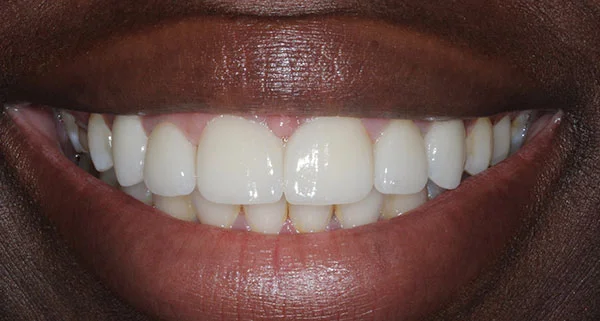 Porcelain Veneers