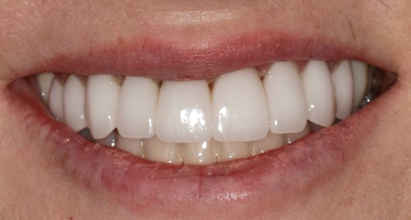 porcelain veneers after