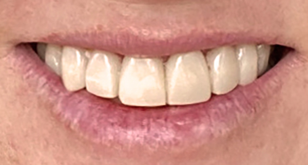 porcelain veneers before