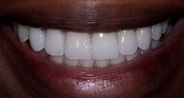 porcelain veneers after