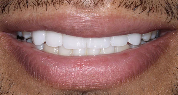 porcelain veneers after