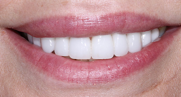 porcelain veneers after