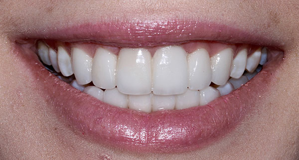 porcelain veneers after