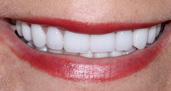 porcelain veneers after