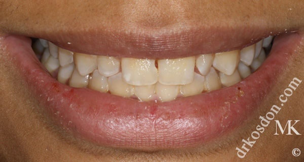 porcelain veneers before