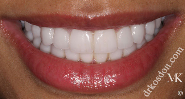 porcelain veneers after