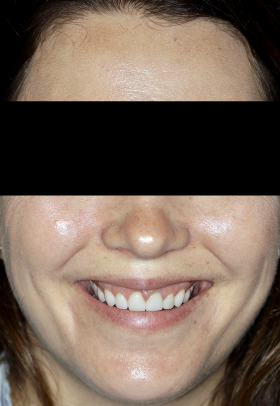 Porcelain Veneers After