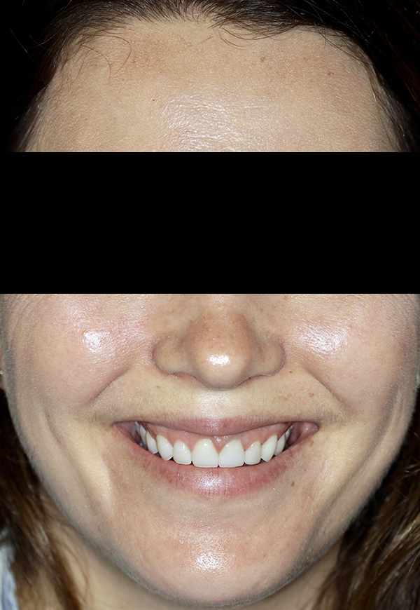 porcelain veneers after