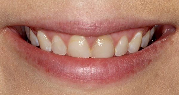 porcelain veneers before