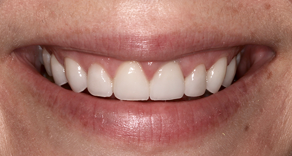 porcelain veneers after