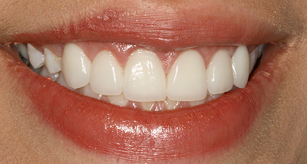 porcelain veneers after