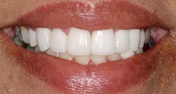 porcelain veneers after