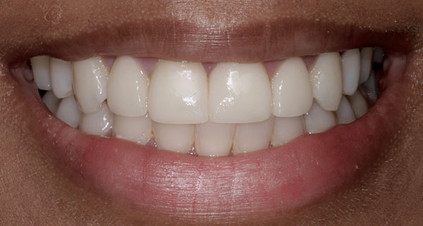 porcelain veneers before