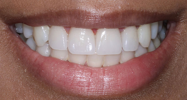 Porcelain Veneers