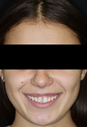 Porcelain Veneers Before