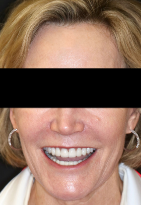 Porcelain Veneers After