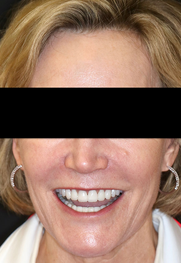 porcelain veneers after